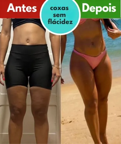 Antes e depois: coxas sem flacidez